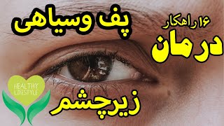 درمان پف وسیاهی زیر چشم : 16 راهکار|How To Get Rid Of Eye Bags \u0026 Dark Circles Under Eyes