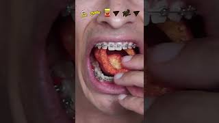 what happens when you eat spicy chips with braces!?