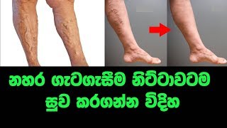 නහර ගැටගැසීම නිට්ටාවටම සුව කරගන්න වීදිය | Natural treatments to get rid of varicose veins