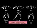 alar ligament radiology msk ligament