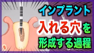 【痛くない】インプラントを入れる穴の形成と埋入の流れについて専門歯科医が解説します【歯医者】