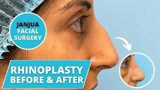 RHINOPLASTY BEFORE AND AFTER (NASAL HUMP REMOVAL) - DR. TANVEER JANJUA - NEW JERSEY