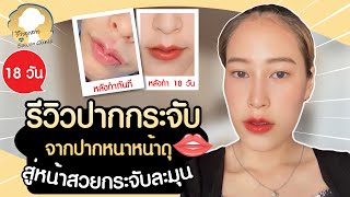 รีวิวปากกระจับ 18 วัน เปลี่ยนจากสาวหน้าดุ เป็นสาวหวาน I รีวิวลูกสาวหมอ Sowon clinic ep.197