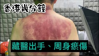 香港幾分鐘｜藏醫出手、周身瘀傷｜大肥｜齋吹