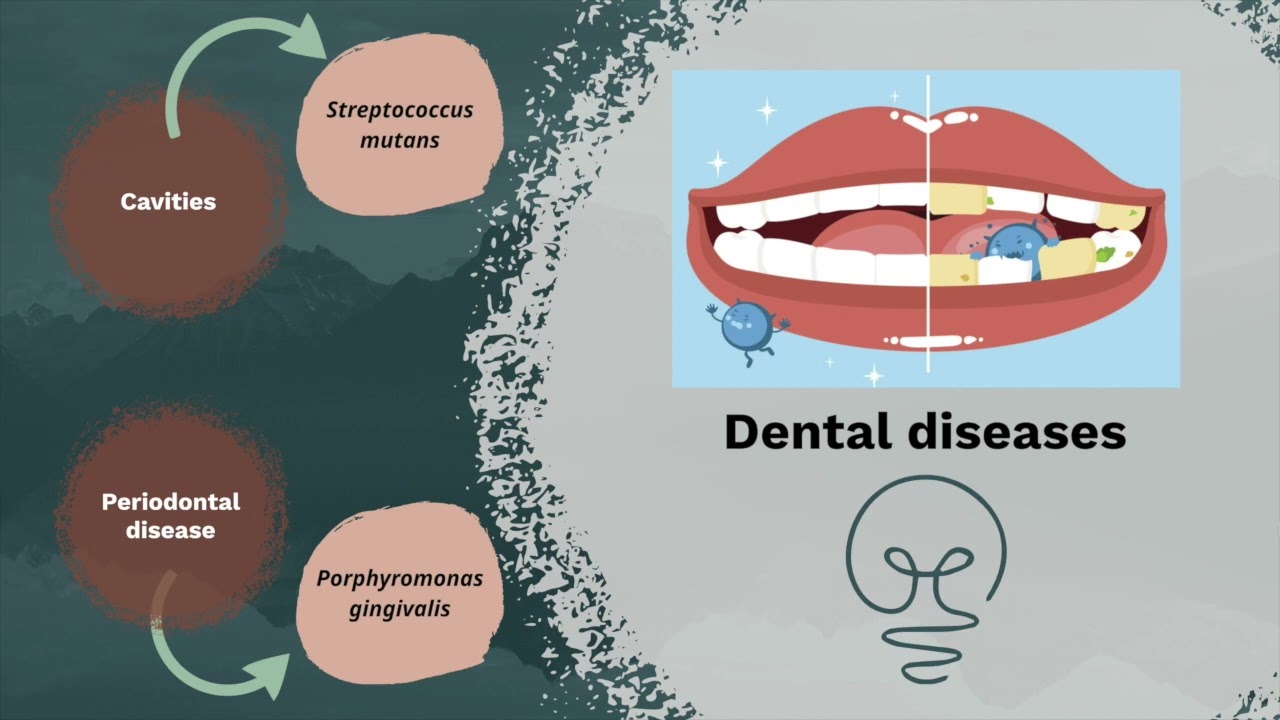 Oral Microbiome In Dental Disease - YouTube