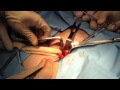 No Mesh Inguinal Hernia Repair - Dr. Robert Tomas, U First Health