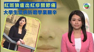 健康360 TVB｜紅斑狼瘡出紅疹關節痛 致腎臟發炎及腦部受影響 大學生受病折磨學業艱辛 一輩子要與紅斑狼瘡共存 生物製劑治療減少藥物｜ 黃靖婷｜最強生命線