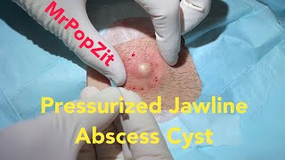 Pressurized Jawline Abscess Cyst. Squirting cyst pop with surprising large sac dissection on neck.