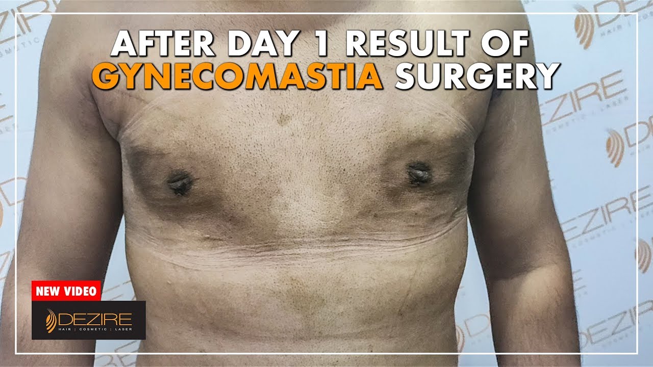 Gynecomastia Surgery Recovery Update | 1 Day Post Surgery Result ...