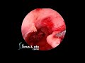 Cartilage Tympanoplasty