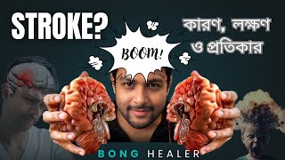 Stroke: স্ট্রোকের কারণ, লক্ষণ ও ঝুঁকি এড়ানোর উপায় |