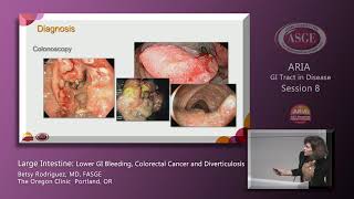Large Intestine in Disease: Lower GI Bleeding, Colorectal Cancer and Diverticulitis