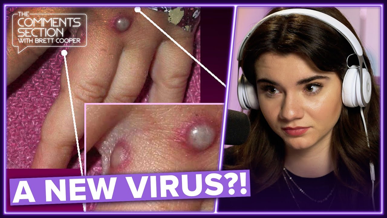 The Newest Virus Doesn’t Seem to Be Monkey-Ing Around