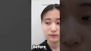 Rhinoplasty in Korea with 2 month results 😍 #plasticsurgeryinkorea