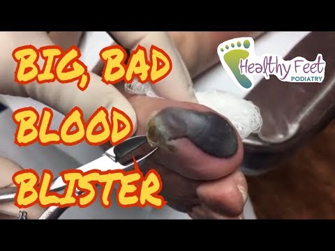Will a blood blister dry up?