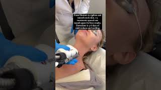 Fraxel to smooth and firm neck skin #antiaging #over40 #fraxel #laser