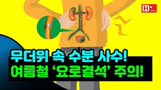 무더위 속 수분 사수! 여름철 '요로결석' 주의!