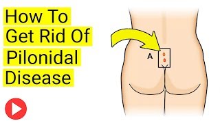 What Is Pilonidal Disease That Tends To Affect Young People
