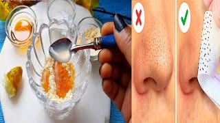 ✔ BLACKHEADS / ব্ল্যাকহেডস দূর করার সহজ ও বৈজ্ঞানিক উপায় । টিনএজ - এডালট সবার জন্য রুটিন