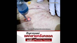 Dr.TATTOF || ลบรอยแตกลาย ด้วย Program PicoWay Resolve