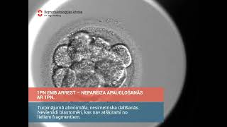 1 PN Embryo Arrest - Nepareizā apaugļošanās ar 1 PN_iVF Riga