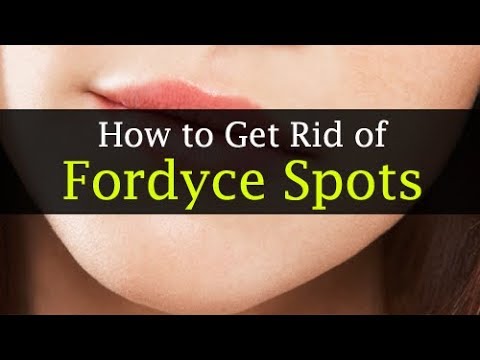How to Get Rid of Fordyce Spots Home Remedies How to Get Rid of Fordyce Spots Home Remedies