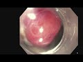 Endoscopic Management of Esophagogastric Anastomotic Disruption with Endoluminal Negative Pressu...