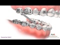 Orthodontic Treatment for Overjet (Overbite) - Forsus Appliance