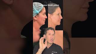 MicroLift vs Deep Plane Facelift