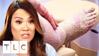Treating The Most Extreme Case Of Scaly Skin! | Dr. Pimple Popper: This Is Zit