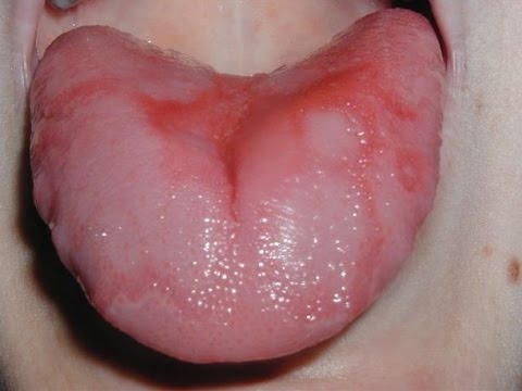 How to Treat Burning Tongue Syndrome How to Treat Burning Tongue Syndrome