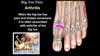 Big Toe Pain  - Everything You Need To Know - Dr. Nabil Ebraheim