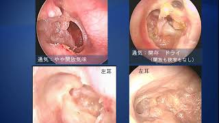 癒着性中耳炎の耳管機能評価