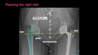 Unique Hip Anatomy Restoration with TraumaCad