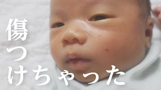 顔に傷できた【新生児】