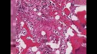 Histopathology Bone Marrow--Chronic idiopathic myelofibrosis