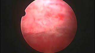 Diagnostic hysteroscopy in missed abortion