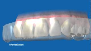 How The NEW Crest Whitestrips Advanced Seal Works