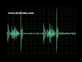 post fontan procedure with ventricular septal defect normal speed