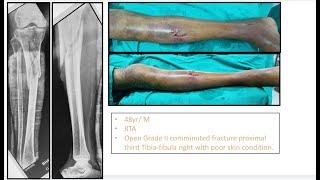 Open Grade II Comminuted Fracture proximal tibia treated with Ilizarov Fixator.