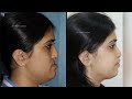 how long is the recovery process after jaw surgery faqs