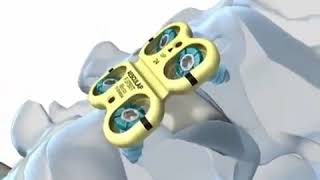 B.Braun Aesculap: ABC2 Anterior Cervical Plating System