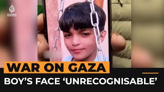 Injured Palestinian boy in Gaza no longer recognises his own face | Al Jazeera NewsFeed