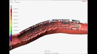 Simulation Video of Nitinol Actuator and Peripheral Stent Deployment and Articulation