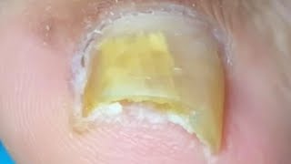 Onychomycosis Is Obviously Deformed, So Trim It Gently【Crazy pedicure room】