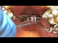 HYRAX  rapid palatal expansion activation in orthodontics by Dr. Amr Asker