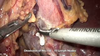 Totally laparoscopic total gastrectomy D2+LN.No10 dissection+overlap anastomosis