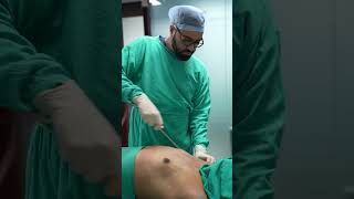 Gynecomastia Surgery in delhi  #shortvideo #shots #dezireclinicindia