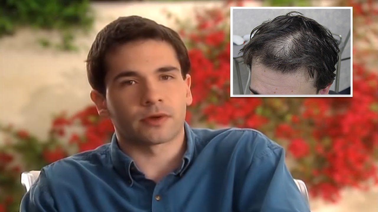 Scalp Med® Review - How To Fix Bald Spots? - Simon M. - YouTube