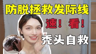 【防脱指南】发际线+秃头自救！养出浓密秀发！